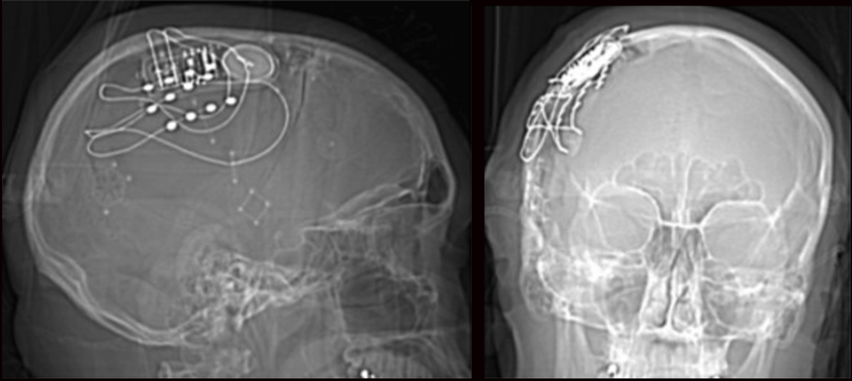 Post-implant lateral and PA skull X-ray showing placement of three NeuroPace Cortical Strip Leads